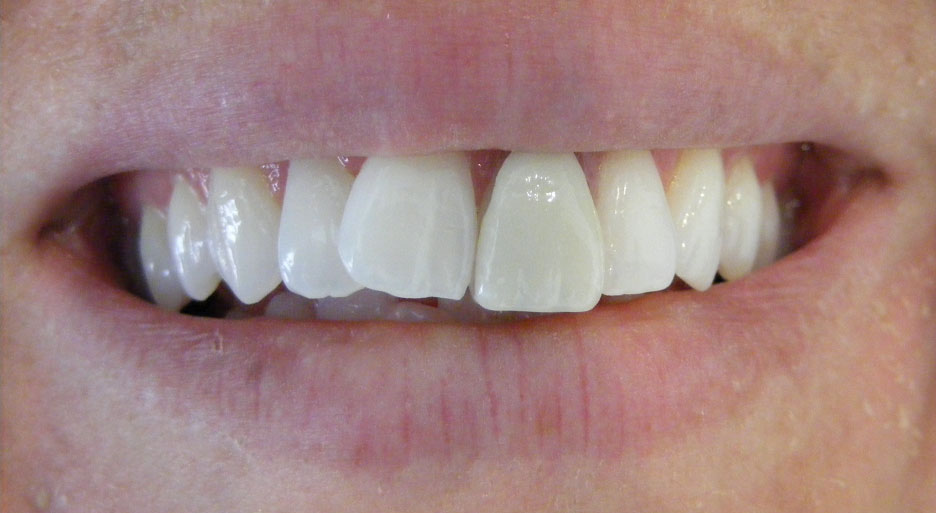 Before single tooth implant
