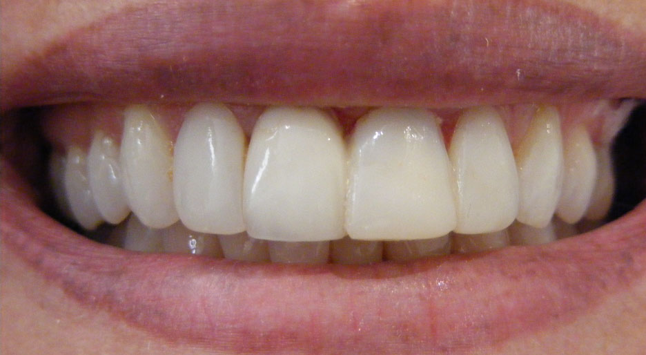 After single tooth implant